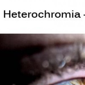 Heterochromia A Beautiful Mutation 